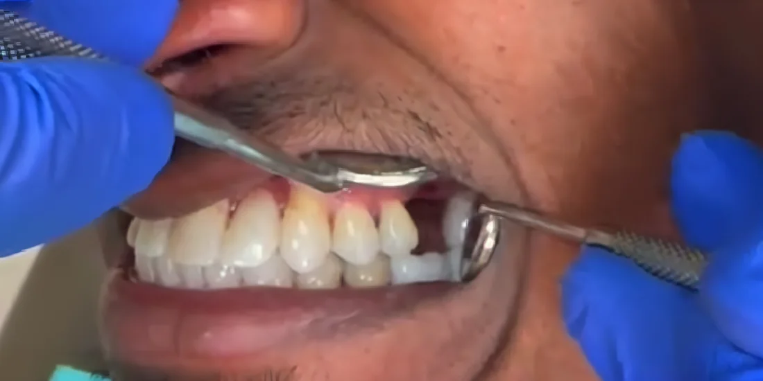 Before photo, Gum health restored and smile brightened, Titanium Dental patient