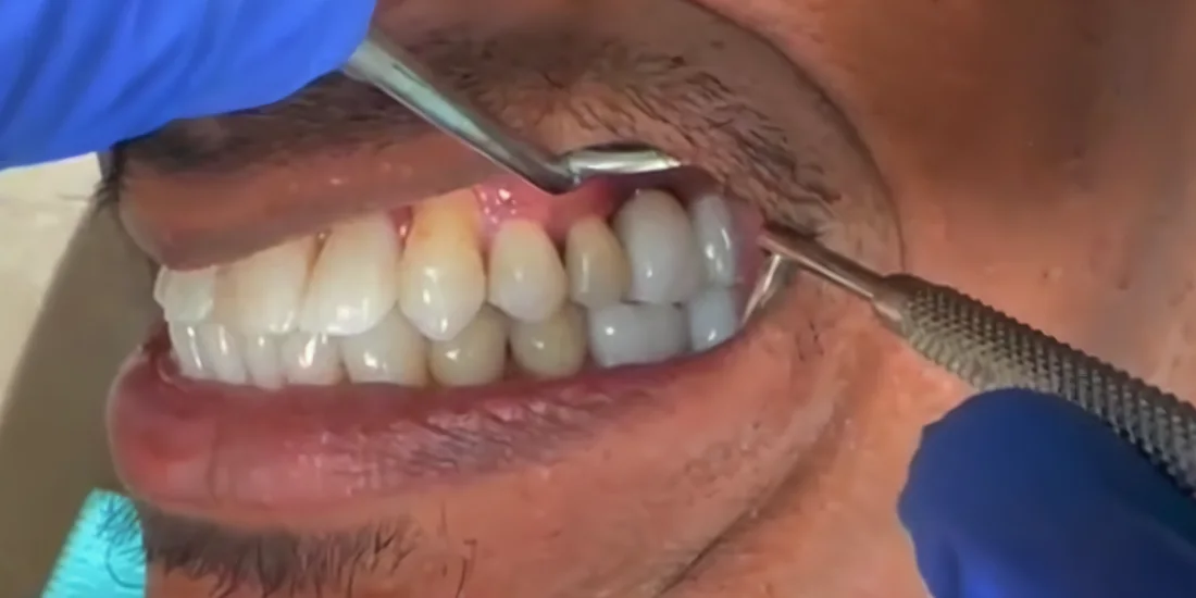 After photo, Gum health restored and smile brightened, Titanium Dental patient