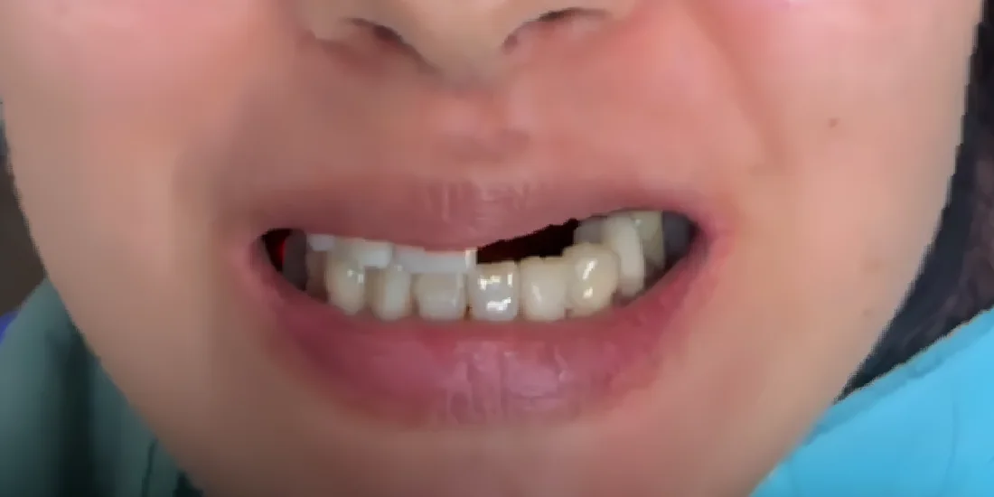 Before photo, Missing tooth replaced with a natural implant crown, Titanium Dental patient