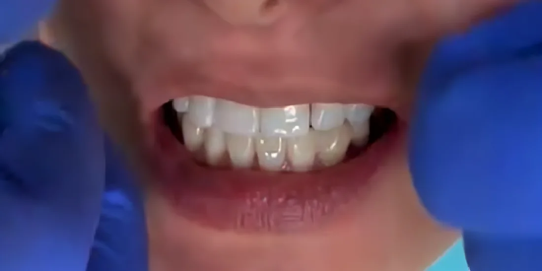 After photo, Missing tooth replaced with a natural implant crown, Titanium Dental patient