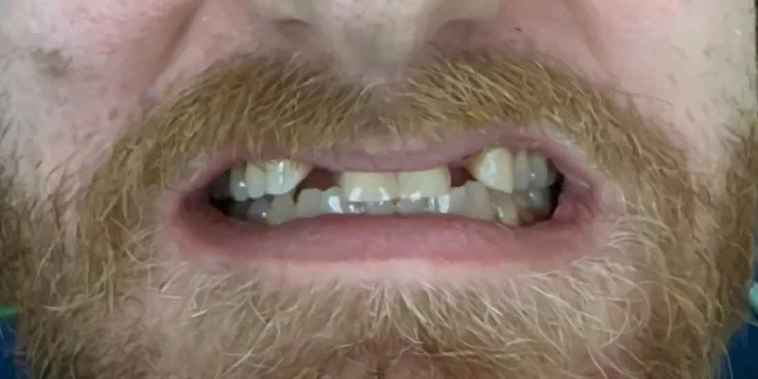 Before photo, Worn smile rebuilt with implant restorations, Titanium Dental patient