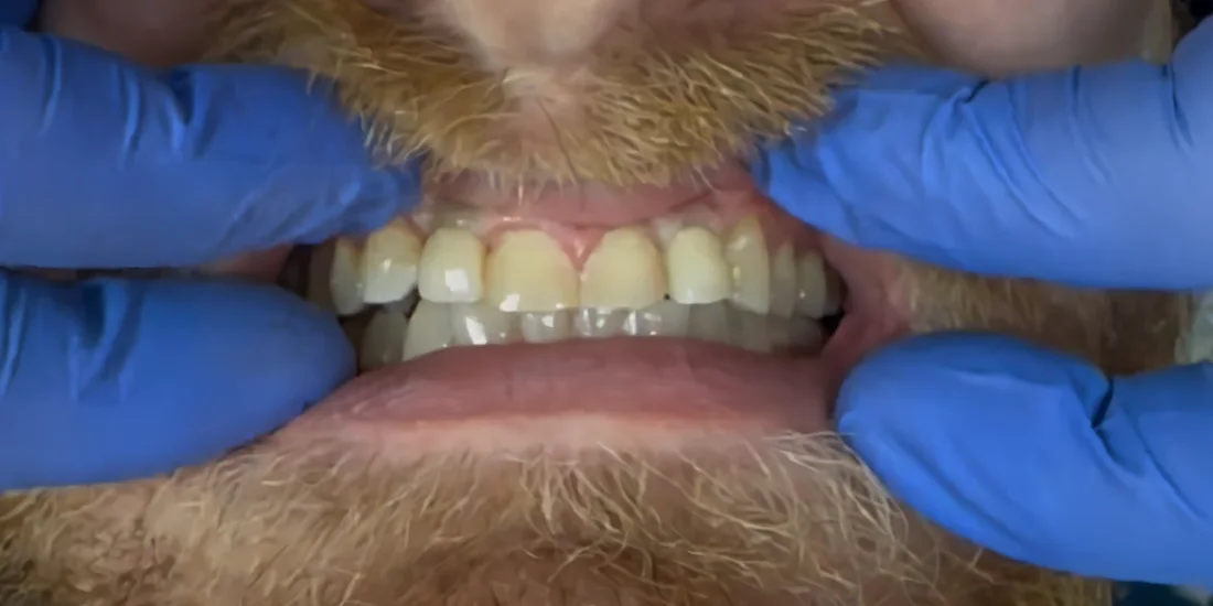 After photo, Worn smile rebuilt with implant restorations, Titanium Dental patient