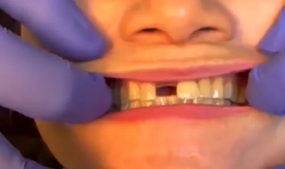 Before photo, Single front tooth replaced with an implant crown, Titanium Dental patient