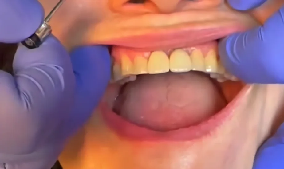 After photo, Single front tooth replaced with an implant crown, Titanium Dental patient