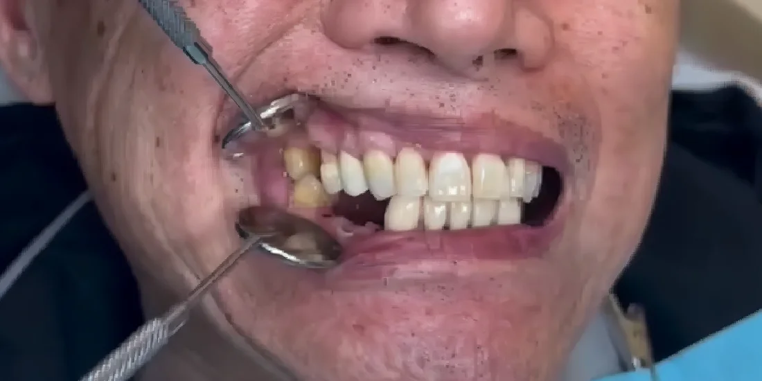 Before photo, Failing teeth replaced with implant-supported teeth, Titanium Dental patient