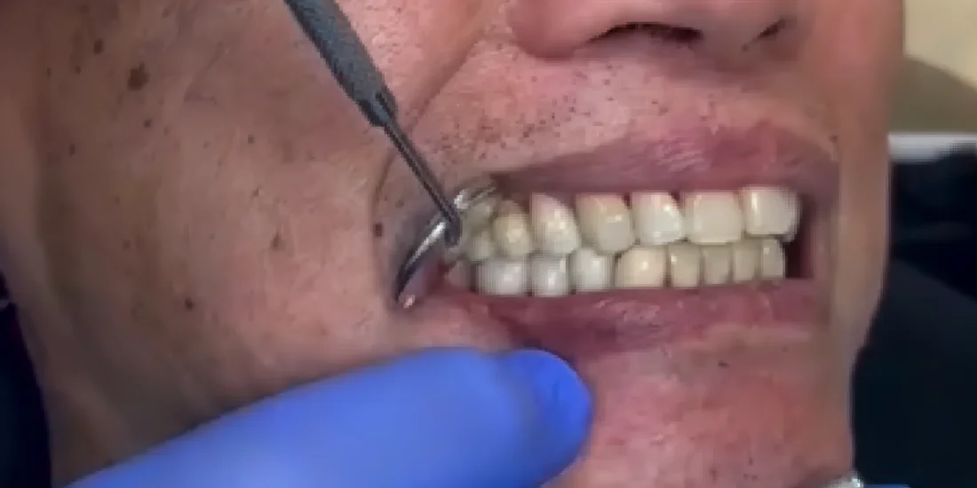 After photo, Failing teeth replaced with implant-supported teeth, Titanium Dental patient