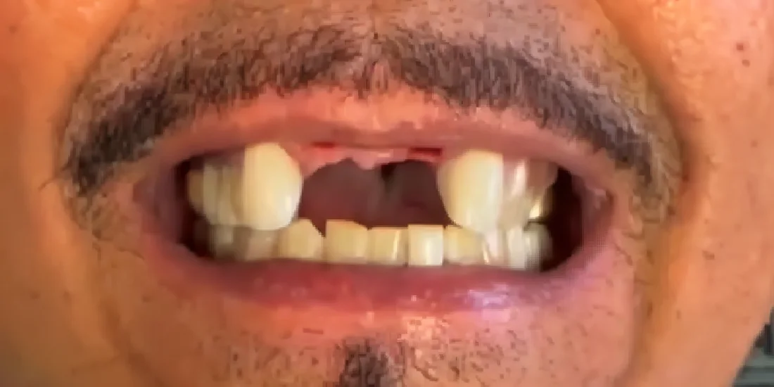 Before photo, Full smile restored with implant-supported teeth, Titanium Dental patient