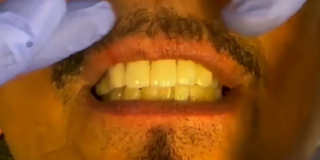 After photo, Full smile restored with implant-supported teeth, Titanium Dental patient